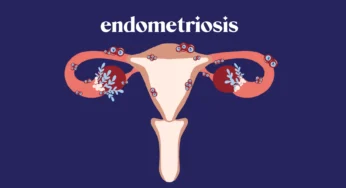 Endometriosis: Mengenali Gejalanya dan Perawatan Holistik yang Bisa Dilakukan