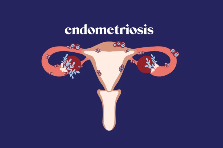Endometriosis: Mengenali Gejala dan Cara Mengatasi dengan Perawatan Holistik