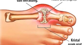 Waspadai 8 Gejala Asam Urat: Apa yang Harus Anda Perhatikan?