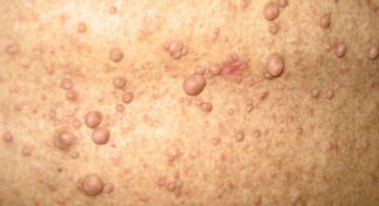 Kenali Gejala Awal Neurofibromatosis Tipe 1 pada Anak
