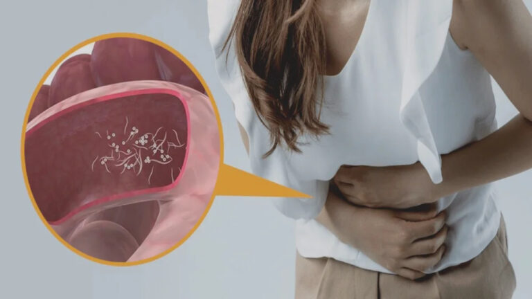 Gejala Cacingan pada Orang Dewasa yang Jarang Disadari