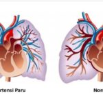 Hipertensi Paru: Penyakit Mematikan yang Sering Tak Disadari