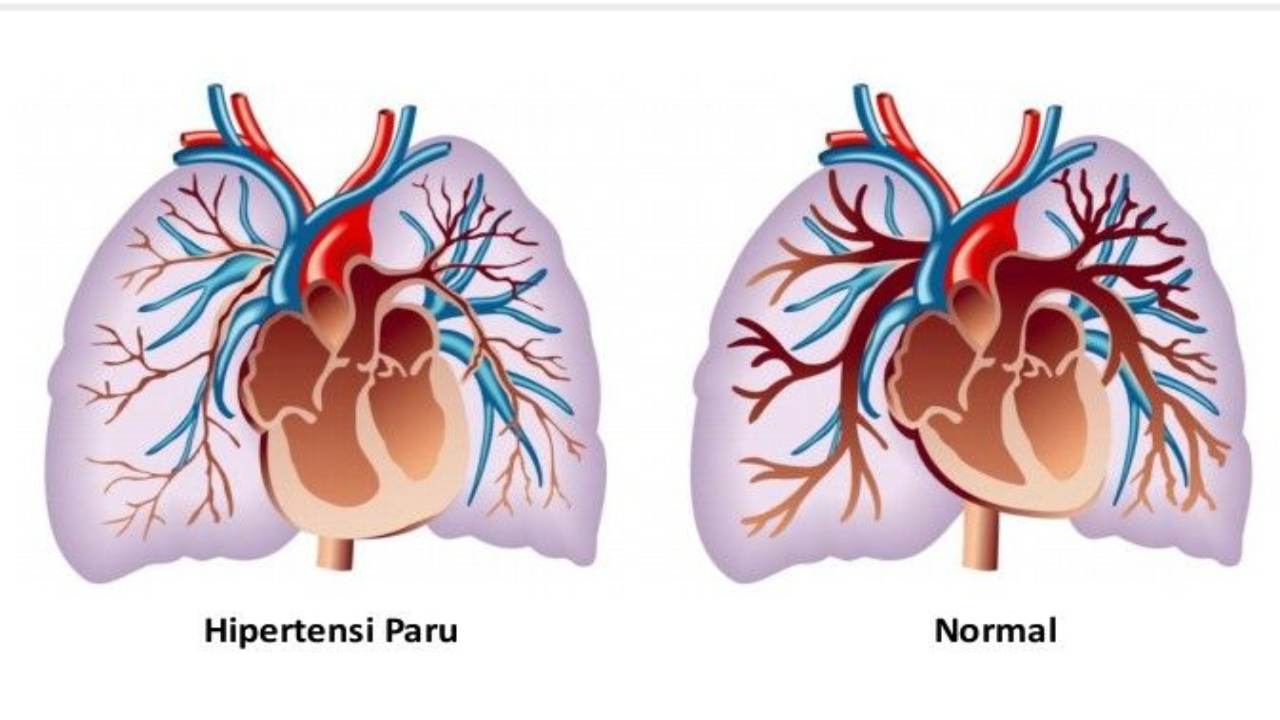 Hipertensi Paru: Penyakit Mematikan yang Sering Tak Disadari