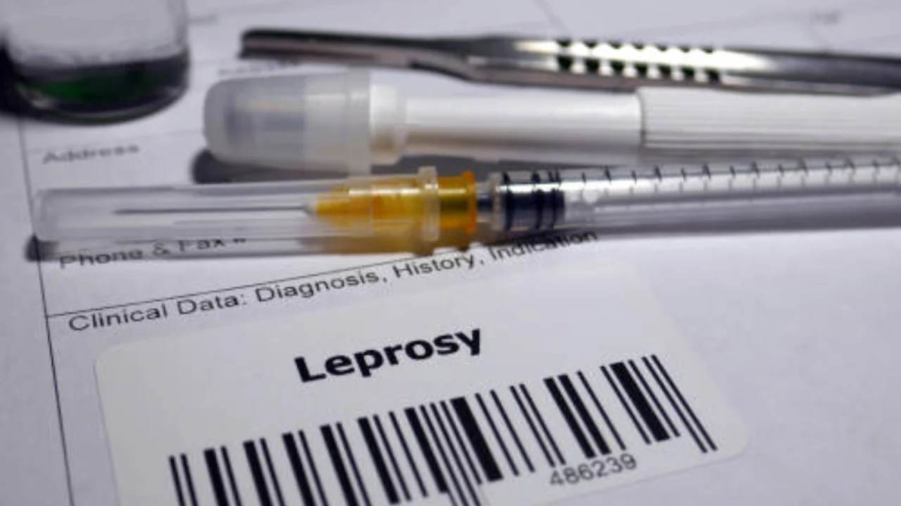 Dua WNI Terdiagnosis Kusta di Rumania, Alarm Kesehatan Global Setelah 40 Tahun