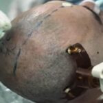 Elon Musk Siap Produksi Massal Chip Otak Neuralink Mulai 2026