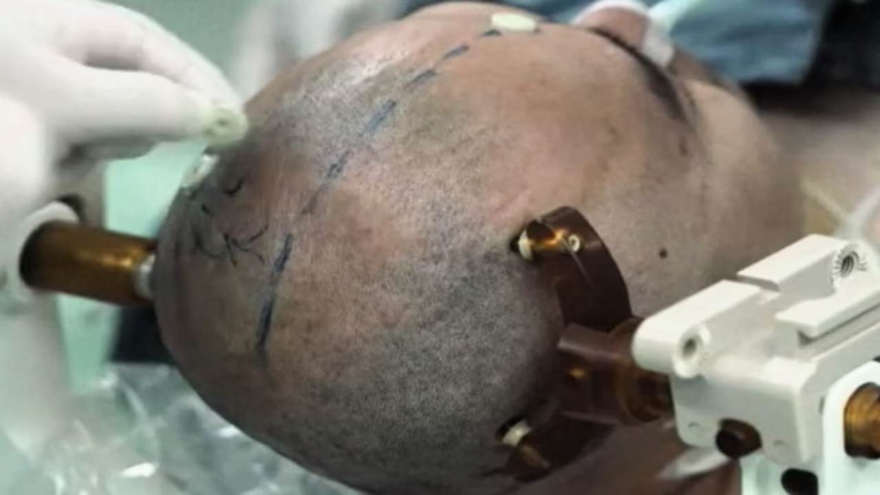 Elon Musk Siap Produksi Massal Chip Otak Neuralink Mulai 2026